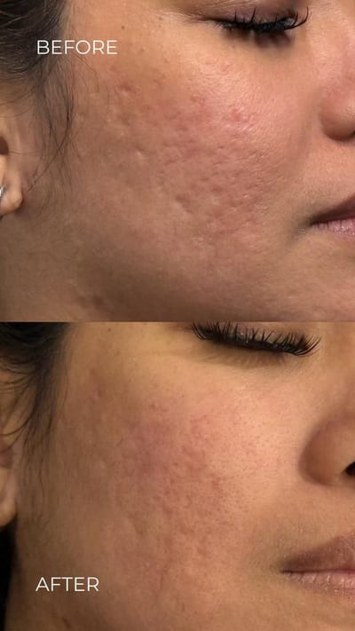 Close-up of clinical skin clearing treatment removing a small benign skin lesion